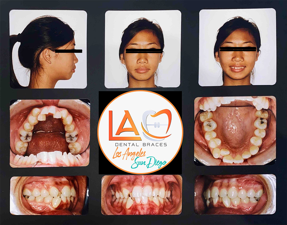 Before and After Photos LA Dental Braces
